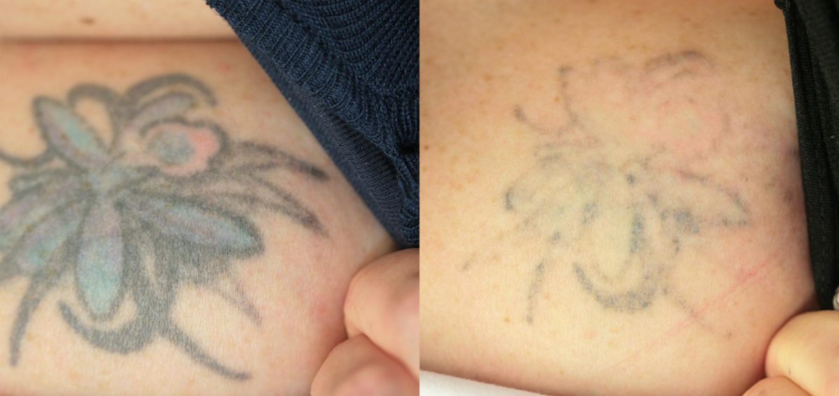 What Are The Benefits Of Using Tattoo Numbering Cream?
